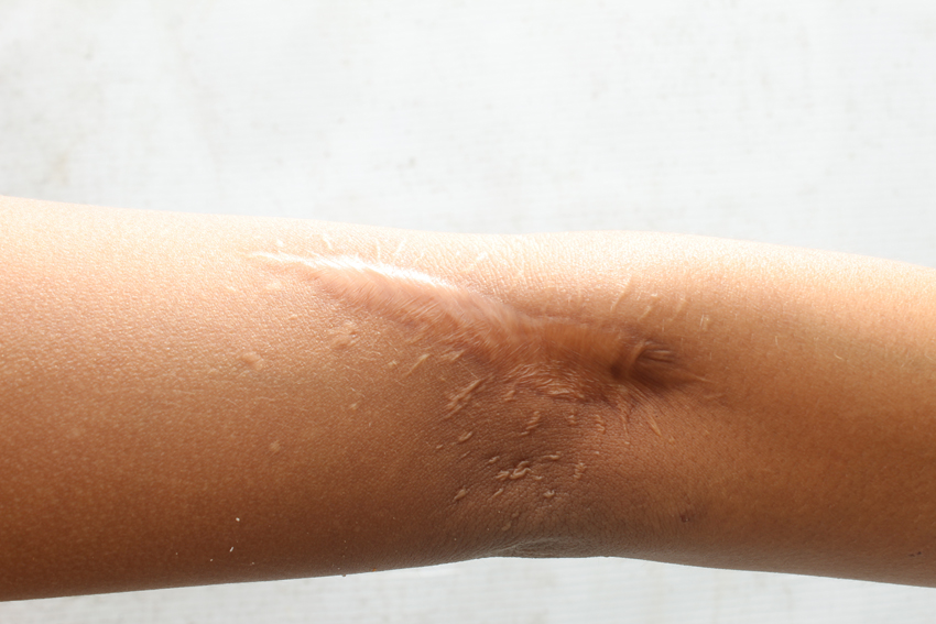 Cicatrização E Cicatrizes: Quais Os Cuidados Que Devemos Ter Com Elas?